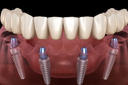 Transform Your Smile with All On 4 Dental Implants A Comprehensive Guide