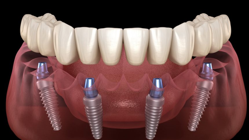 Transform Your Smile with All On 4 Dental Implants A Comprehensive Guide