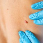 Comprehensive Skin Cancer Check in Wollongong Early Detection and Prevention at Crown Medical Skin Clinic