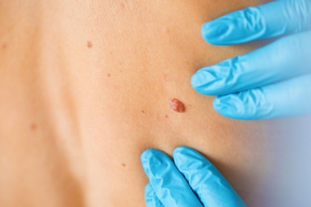 Comprehensive Skin Cancer Check in Wollongong Early Detection and Prevention at Crown Medical Skin Clinic